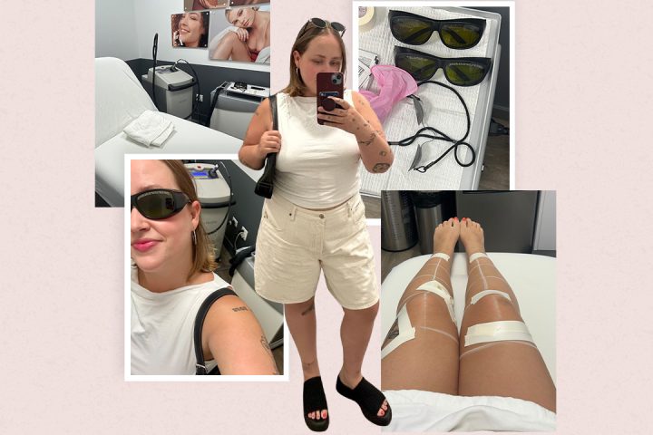 A remoção do cabelo a laser doeu mais do que a depilação? Tudo que você precisa saber